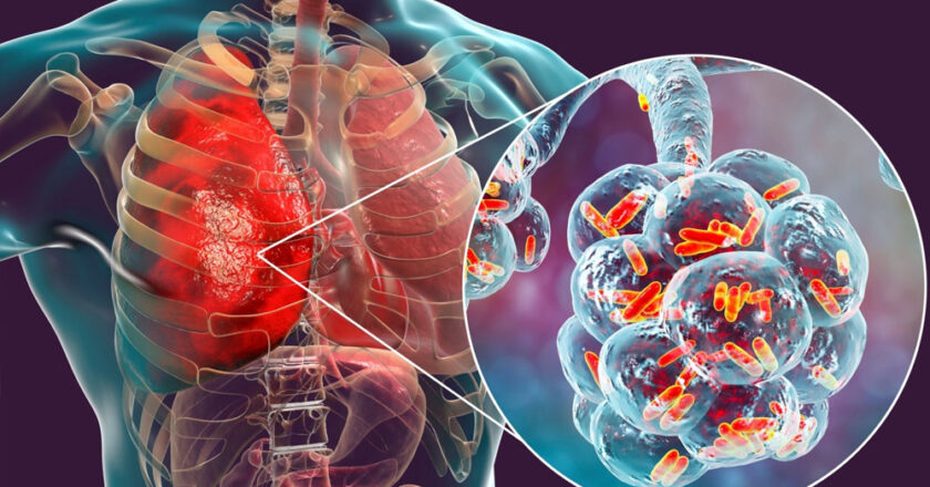मध्य प्रदेश में टीबी के मरीजों की संख्या बढ़ी, सबसे ज्यादा टीबी मरीजों के मामले में एमपी तीसरे नंबर पर