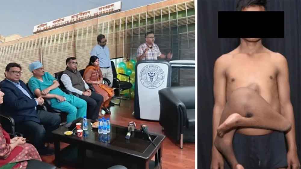 दिल्ली एम्स के सर्जन एक अभूतपूर्व सर्जिकल केस में सफल रहे, परजीवी जुड़वां भाई के अवशेषों को निकालने में सफलता हासिल की