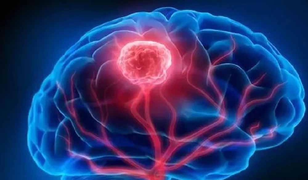 ब्रेन ट्यूमर अब नहीं है लाइलाज, नई तकनीक से सफल इलाज, बीमारी के प्रति फैल रही जागरूक