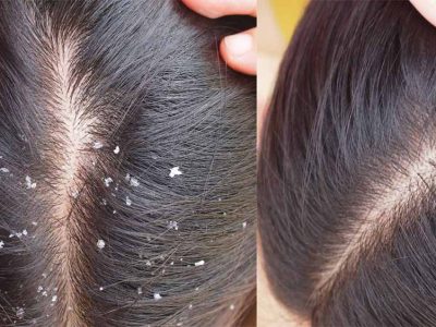 डैंड्रफ नहीं, स्कैल्प की गंभीर समस्या भी हो सकती है! तेल लगाने से पहले जान लें ये सच्चाई