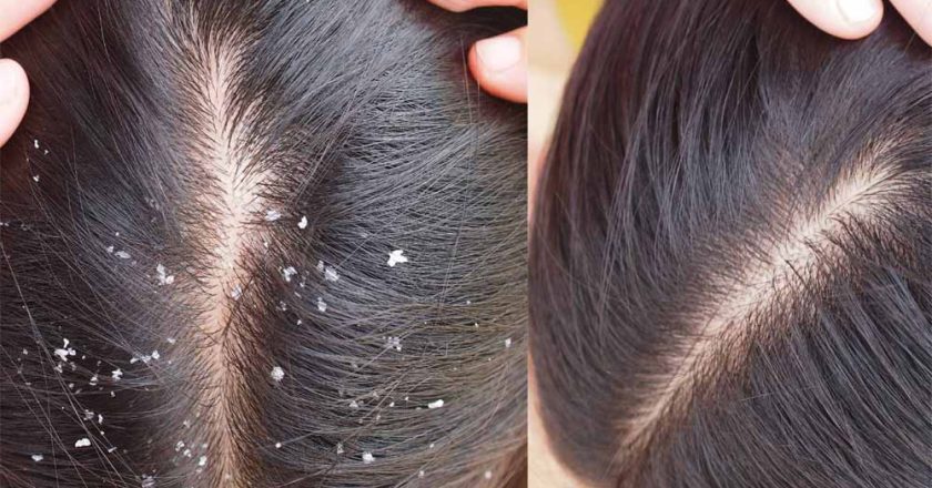 डैंड्रफ नहीं, स्कैल्प की गंभीर समस्या भी हो सकती है! तेल लगाने से पहले जान लें ये सच्चाई