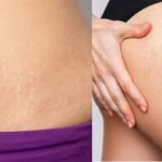 घर बैठे ऐसे मिटाएँ जिद्दी स्ट्रेच मार्क्स, बिना महंगे इलाज के