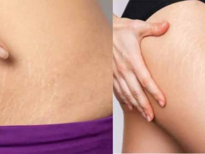 घर बैठे ऐसे मिटाएँ जिद्दी स्ट्रेच मार्क्स, बिना महंगे इलाज के