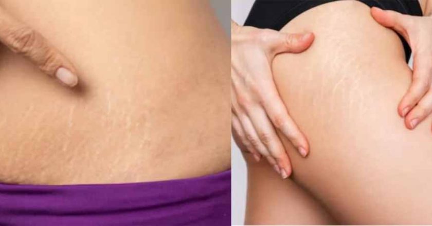 घर बैठे ऐसे मिटाएँ जिद्दी स्ट्रेच मार्क्स, बिना महंगे इलाज के