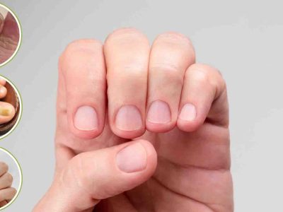 क्या आपके नाखून भी हो रहे हैं पीले या नीले? जानें शरीर में छिपी किन बीमारियों की ओर है यह इशारा