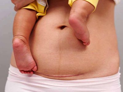 सिजेरियन डिलीवरी का बढ़ता चलन,मेडिकल जरूरत या बड़ा बिज़नेस?