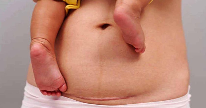 सिजेरियन डिलीवरी का बढ़ता चलन,मेडिकल जरूरत या बड़ा बिज़नेस?